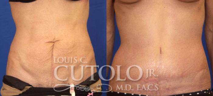 Before & After Tummy Tuck Case 44 View #1 View in Brooklyn, Staten Island, Queens, NY