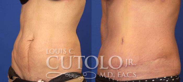 Before & After Tummy Tuck Case 44 View #2 View in Brooklyn, Staten Island, Queens, NY