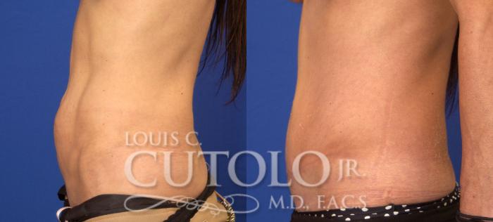 Before & After Tummy Tuck Case 44 View #3 View in Brooklyn, Staten Island, Queens, NY