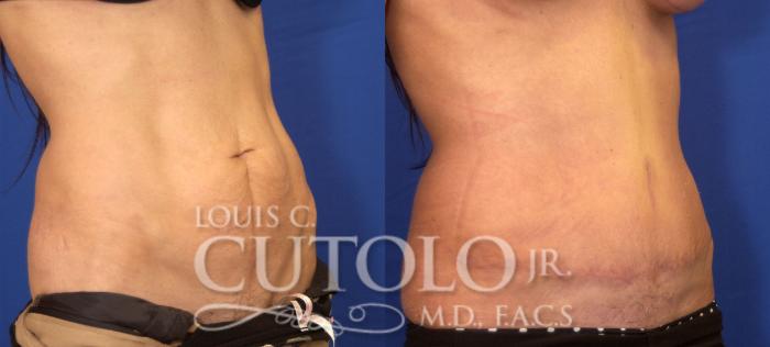 Before & After Tummy Tuck Case 44 View #4 View in Brooklyn, Staten Island, Queens, NY