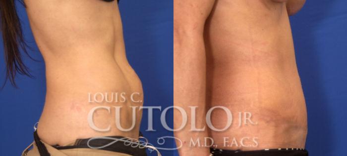 Before & After Tummy Tuck Case 44 View #5 View in Brooklyn, Staten Island, Queens, NY