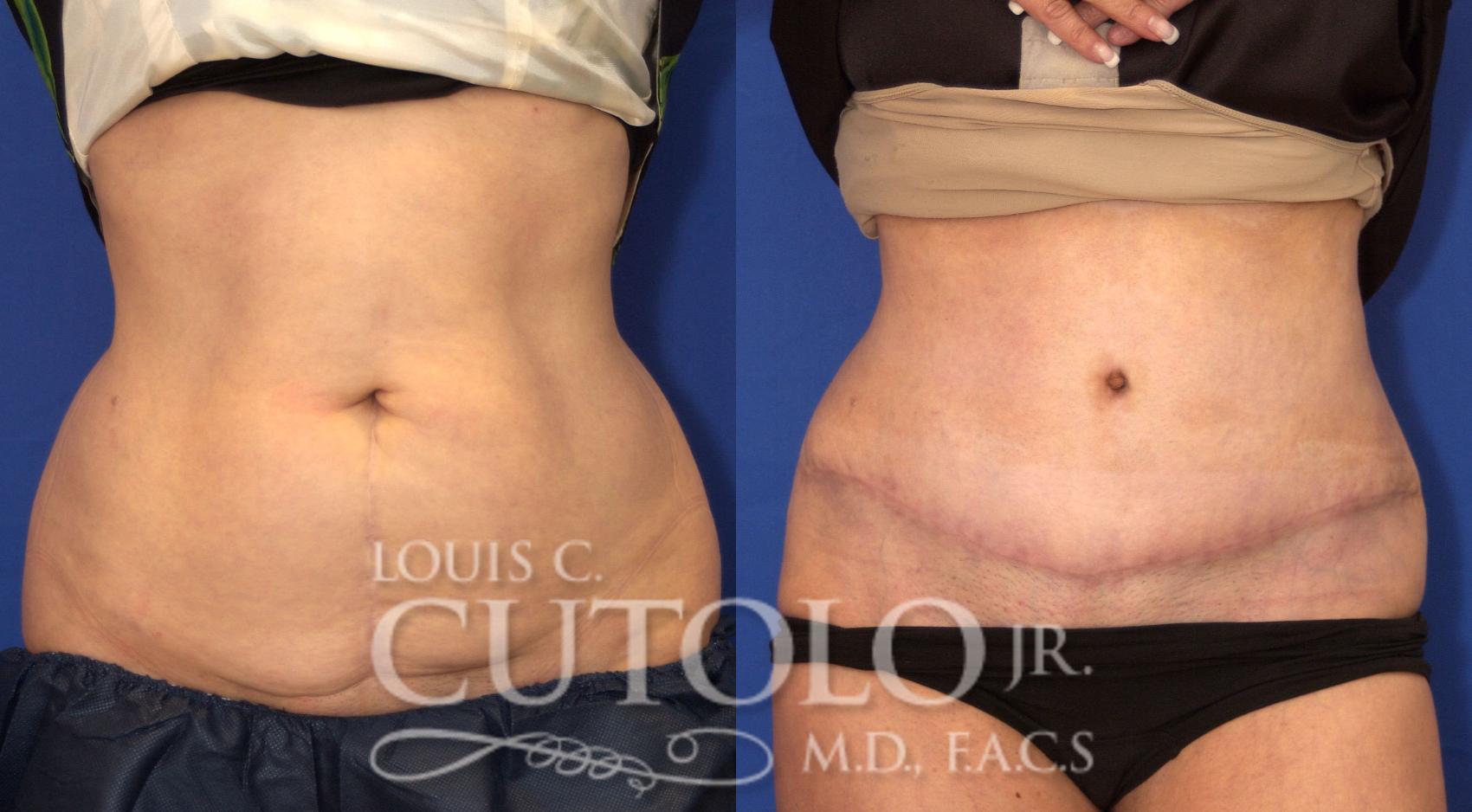 Before & After Tummy Tuck Case 51 View #1 View in Brooklyn, Staten Island, Queens, NY