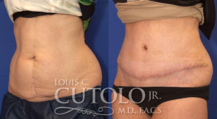 Before & After Tummy Tuck Case 51 View #2 View in Brooklyn, Staten Island, Queens, NY