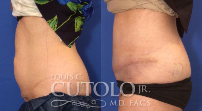 Before & After Tummy Tuck Case 51 View #3 View in Brooklyn, Staten Island, Queens, NY