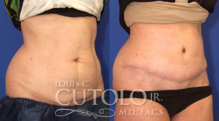 Before & After Tummy Tuck Case 51 View #4 View in Brooklyn, Staten Island, Queens, NY