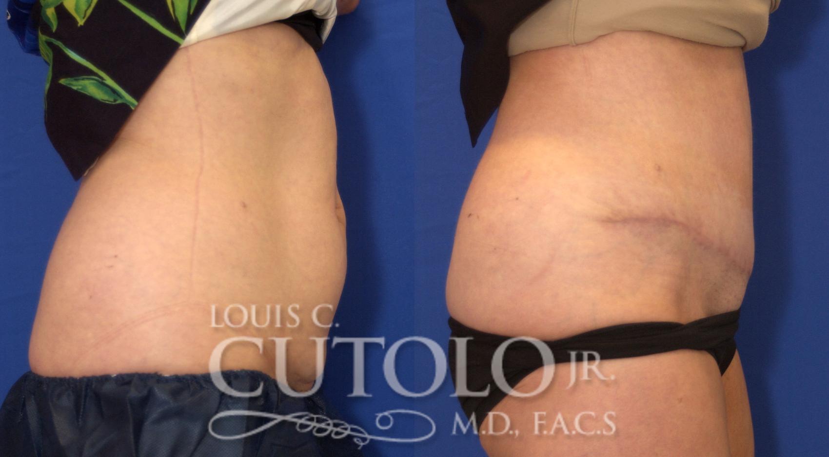 Before & After Tummy Tuck Case 51 View #5 View in Brooklyn, Staten Island, Queens, NY