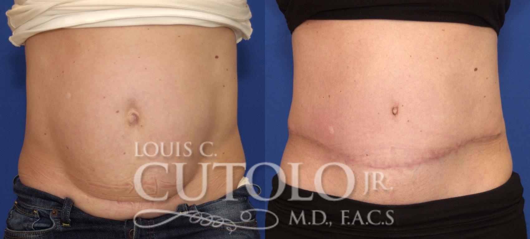 Before & After Tummy Tuck Case 73 View #1 View in Brooklyn, Staten Island, Queens, NY