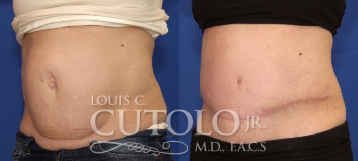 Before & After Tummy Tuck Case 73 View #2 View in Brooklyn, Staten Island, Queens, NY