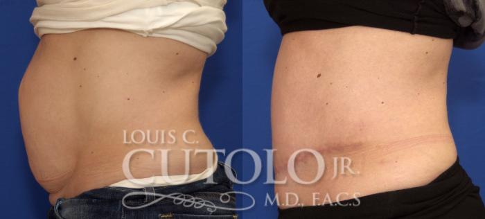 Before & After Tummy Tuck Case 73 View #3 View in Brooklyn, Staten Island, Queens, NY