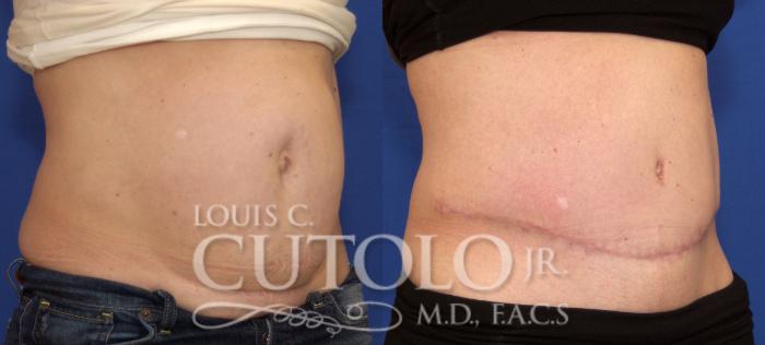 Before & After Tummy Tuck Case 73 View #4 View in Brooklyn, Staten Island, Queens, NY