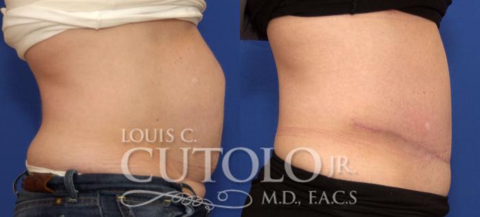 Before & After Tummy Tuck Case 73 View #5 View in Brooklyn, Staten Island, Queens, NY