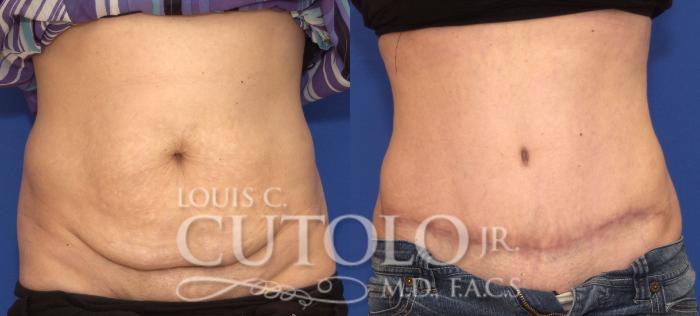Before & After Tummy Tuck Case 80 View #1 View in Brooklyn, Staten Island, Queens, NY