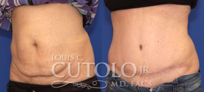 Before & After Tummy Tuck Case 80 View #2 View in Brooklyn, Staten Island, Queens, NY