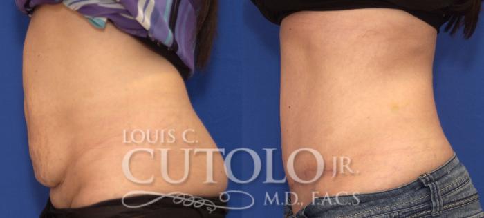 Before & After Tummy Tuck Case 80 View #3 View in Brooklyn, Staten Island, Queens, NY