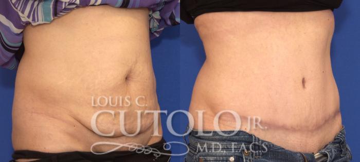 Before & After Tummy Tuck Case 80 View #4 View in Brooklyn, Staten Island, Queens, NY