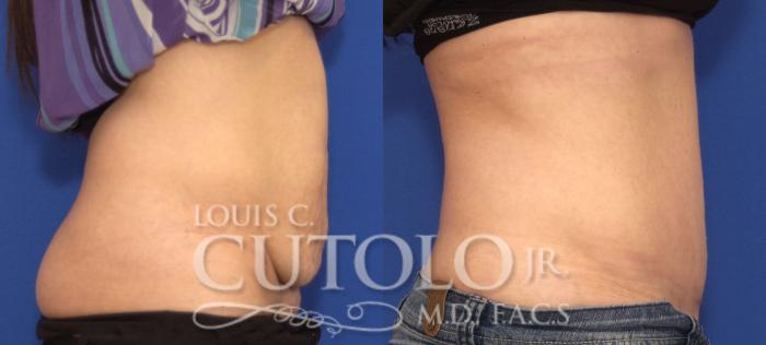 Before & After Tummy Tuck Case 80 View #5 View in Brooklyn, Staten Island, Queens, NY