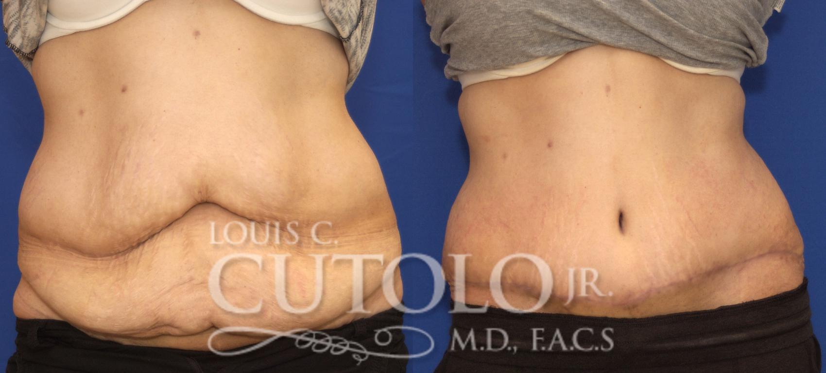 Before & After Tummy Tuck Case 86 View #1 View in Brooklyn, Staten Island, Queens, NY