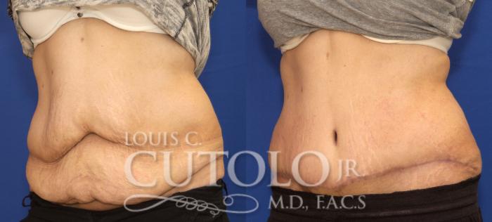 Before & After Tummy Tuck Case 86 View #2 View in Brooklyn, Staten Island, Queens, NY