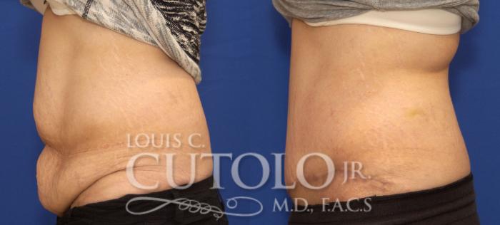 Before & After Tummy Tuck Case 86 View #3 View in Brooklyn, Staten Island, Queens, NY