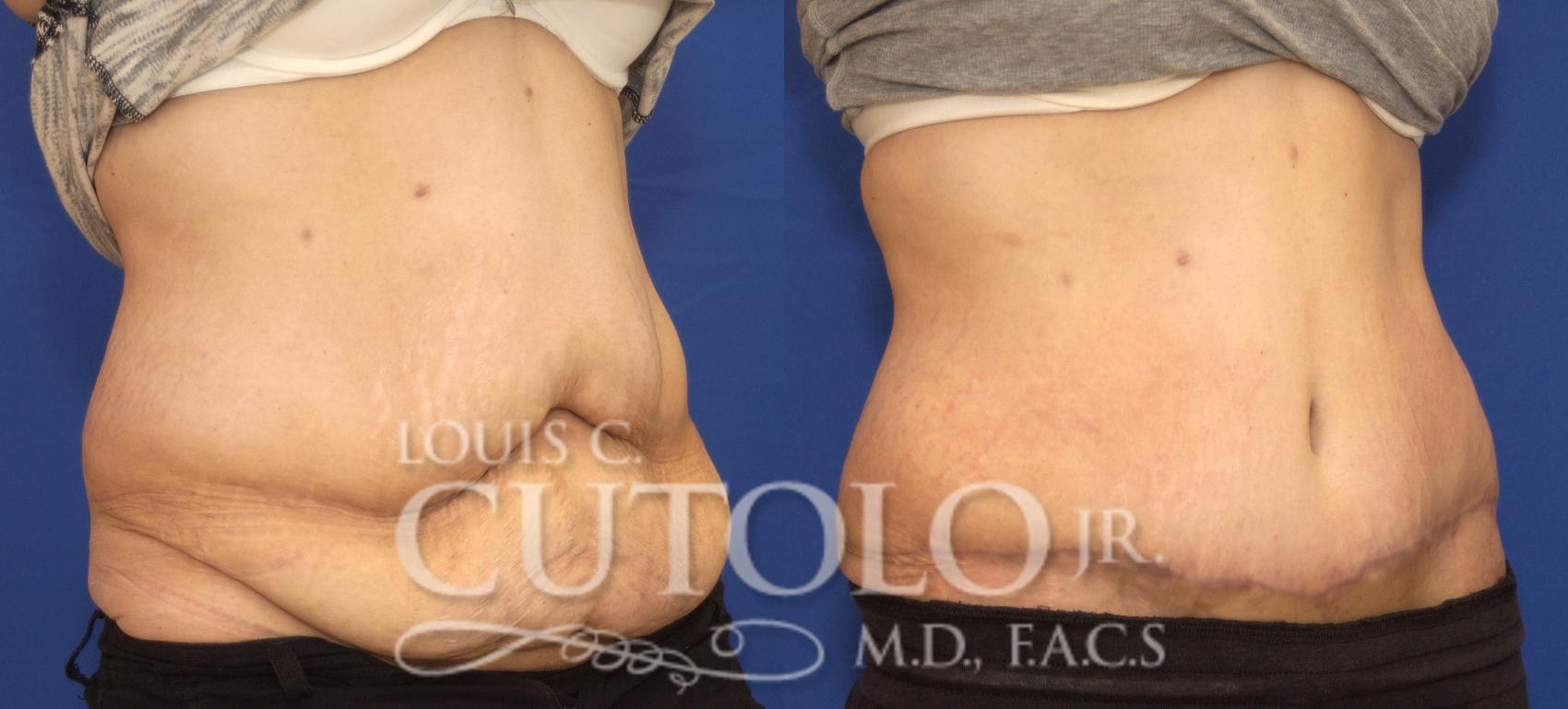 Before & After Tummy Tuck Case 86 View #4 View in Brooklyn, Staten Island, Queens, NY