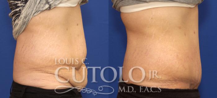 Before & After Tummy Tuck Case 86 View #5 View in Brooklyn, Staten Island, Queens, NY