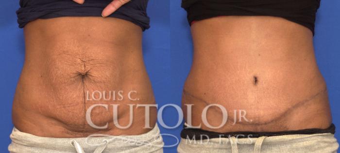 Before & After Tummy Tuck Case 91 View #1 View in Brooklyn, Staten Island, Queens, NY