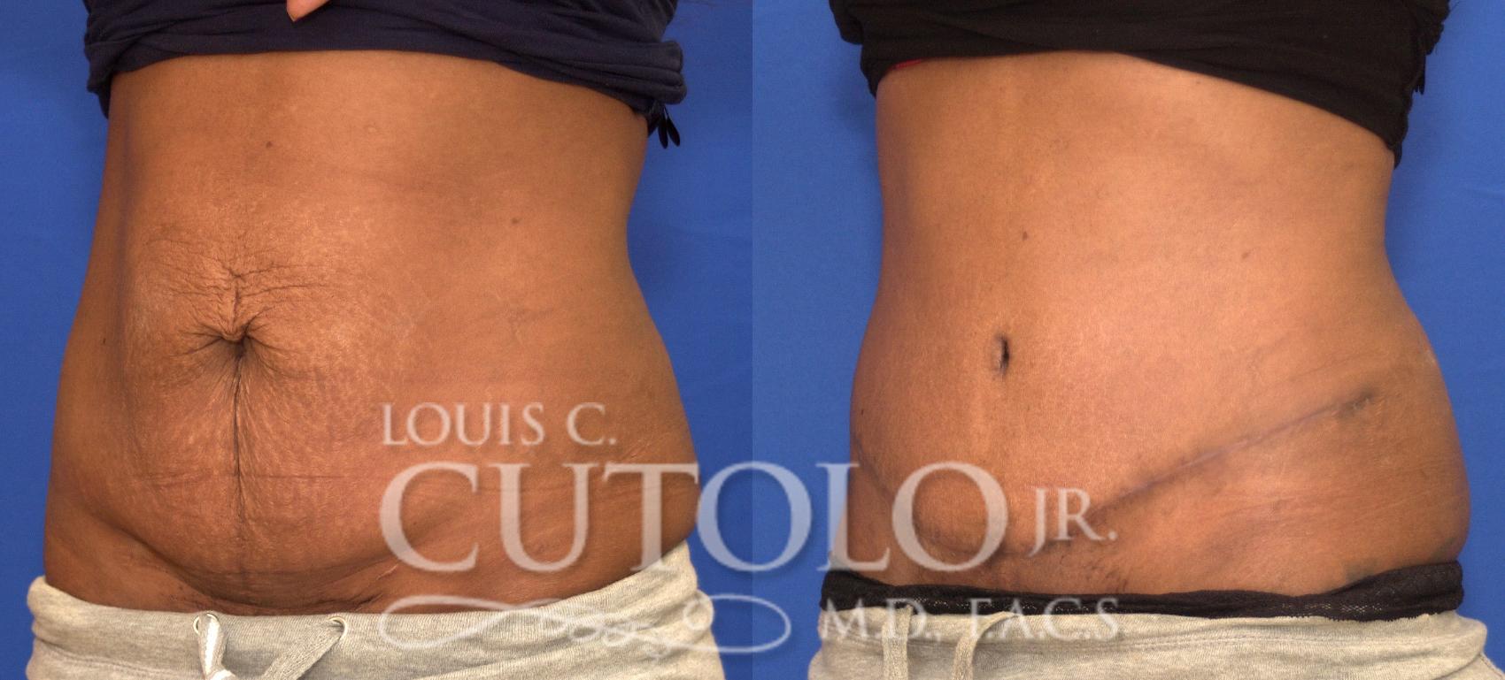 Before & After Tummy Tuck Case 91 View #2 View in Brooklyn, Staten Island, Queens, NY