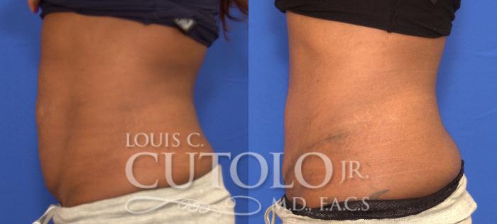 Before & After Tummy Tuck Case 91 View #3 View in Brooklyn, Staten Island, Queens, NY