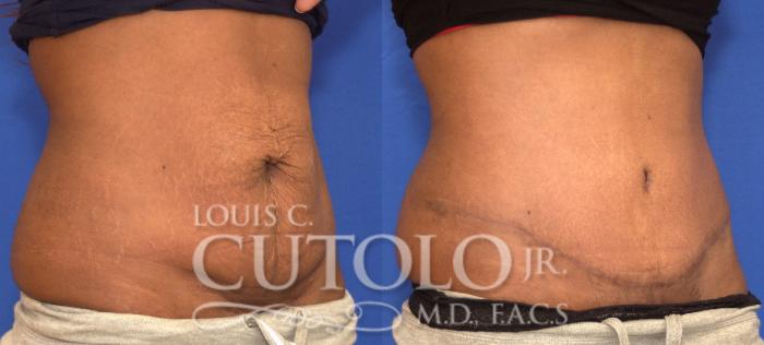 Before & After Tummy Tuck Case 91 View #4 View in Brooklyn, Staten Island, Queens, NY