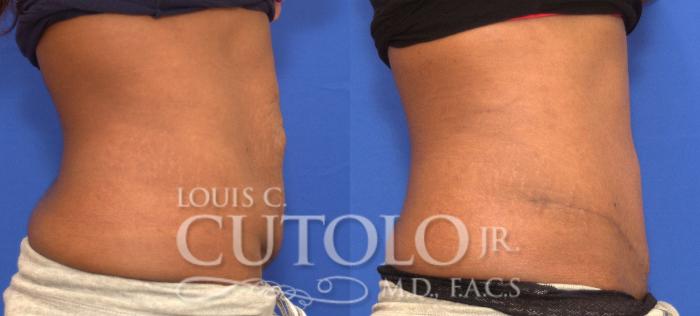 Before & After Tummy Tuck Case 91 View #5 View in Brooklyn, Staten Island, Queens, NY