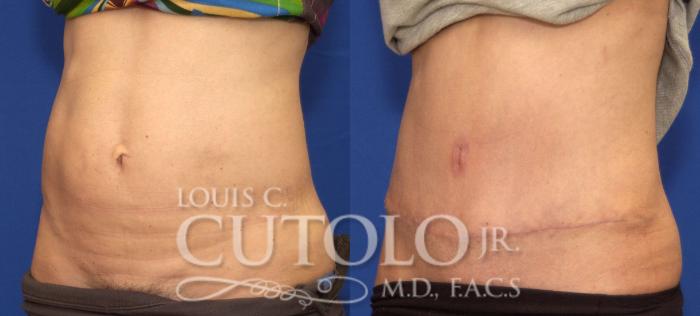 Before & After Tummy Tuck Case 96 View #2 View in Brooklyn, Staten Island, Queens, NY