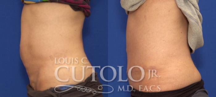 Before & After Tummy Tuck Case 96 View #3 View in Brooklyn, Staten Island, Queens, NY