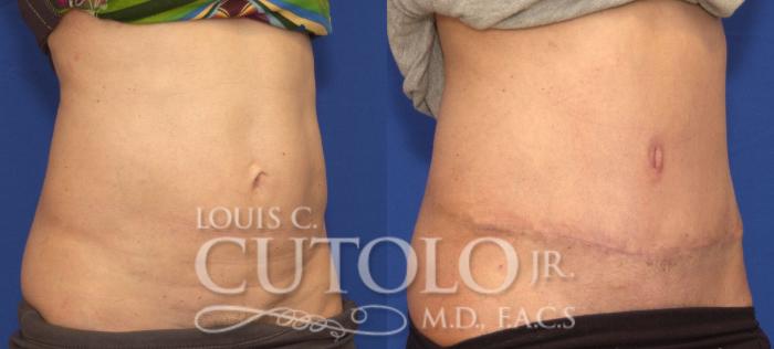Before & After Tummy Tuck Case 96 View #4 View in Brooklyn, Staten Island, Queens, NY