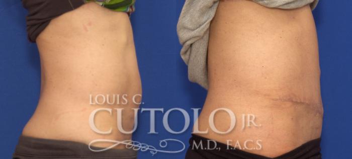 Before & After Tummy Tuck Case 96 View #5 View in Brooklyn, Staten Island, Queens, NY