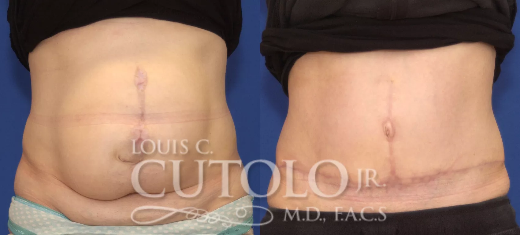 The Tummy Tuck Scar and Dr. Patronella's TRUE FORM ABDOMINOPLASTY® Scar  Treatment - Houston, Texas