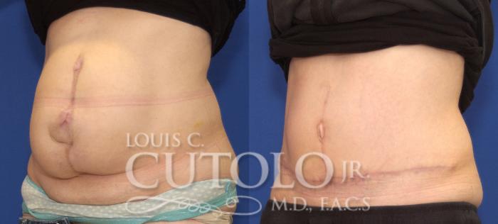 Before & After Tummy Tuck Case 99 View #2 View in Brooklyn, Staten Island, Queens, NY
