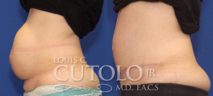 Before & After Tummy Tuck Case 99 View #3 View in Brooklyn, Staten Island, Queens, NY