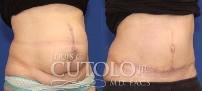Before & After Tummy Tuck Case 99 View #4 View in Brooklyn, Staten Island, Queens, NY