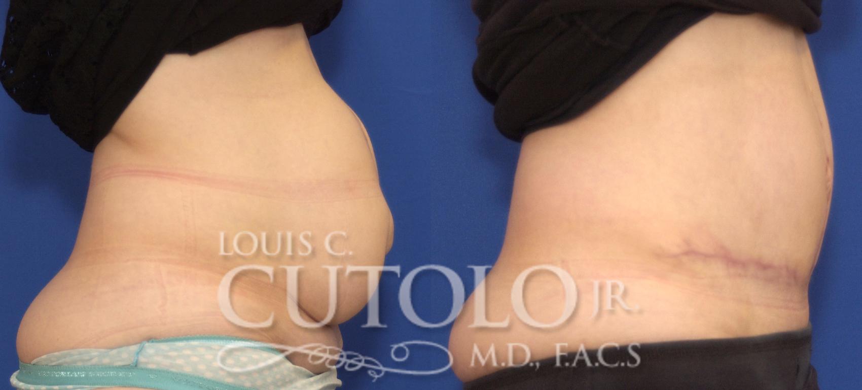 tummy tuck and hernia repair at the same time reinmezquita